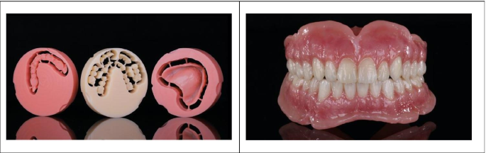 root-canal-treatment