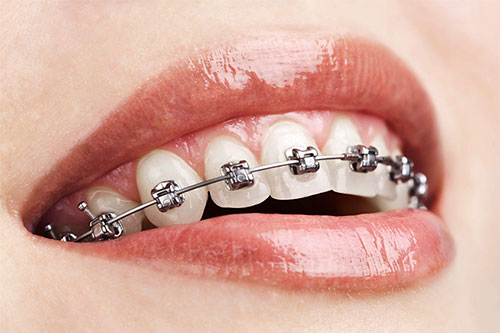 best orthodontics in patuli,garia, kolkata