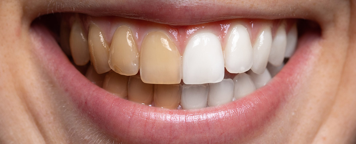 tooth-whitening
